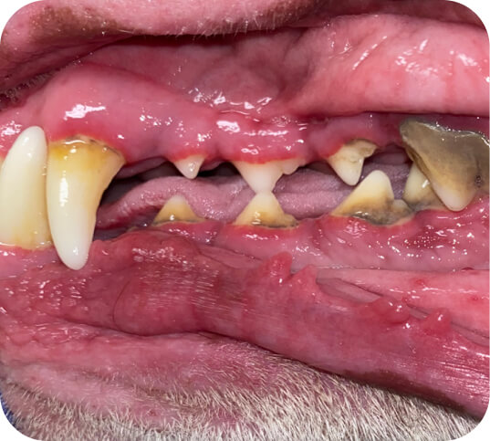 Grade 3 - Heavy buildup
