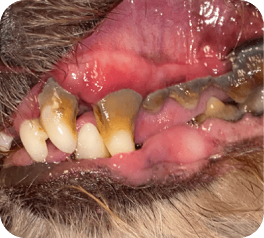 Grade 4 - Severe buildup